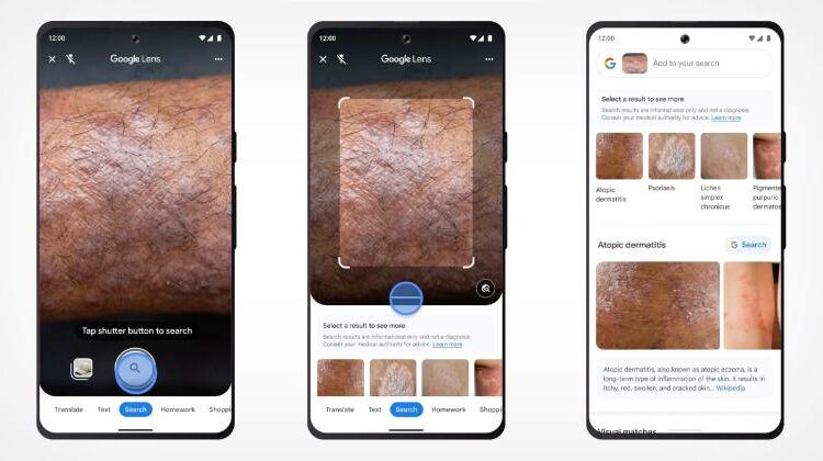 You can now look up skin conditions using Google Lens